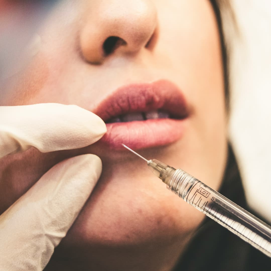 Lippen Hyaluron: Die Kunst des Lippen Aufspritzen für ein Verführerisches Lächeln